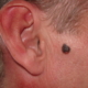 melanoma by ear