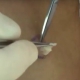 cyst pimple popper