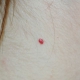 cherry angioma blood vessel