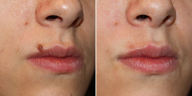 before and after mole removal without stitches