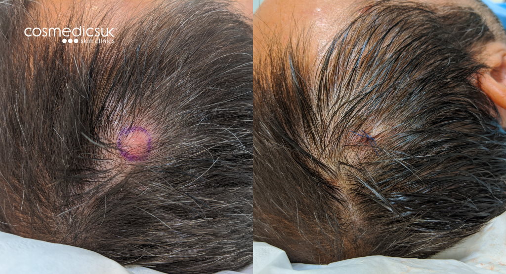 Before and after cyst removal scalp