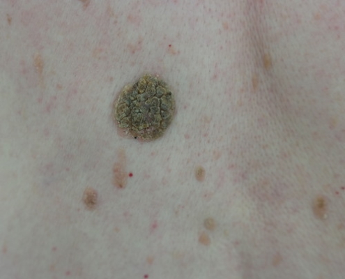 Seborrhoeic keratosis for removal with curettage and cautery