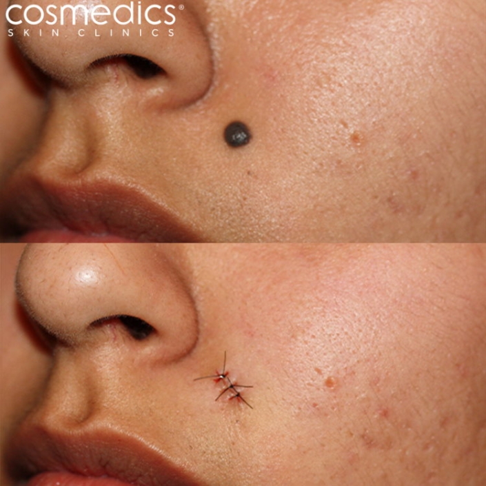 before and after mole removal stitches